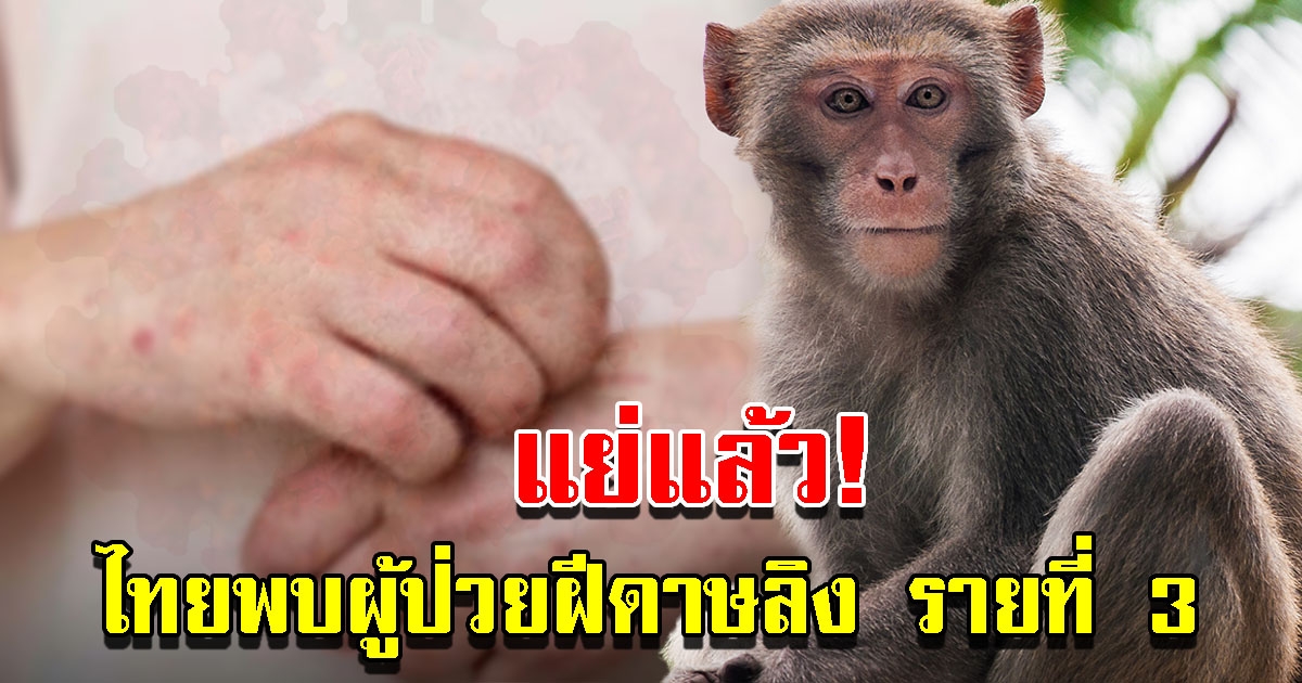 ไทยพบผู้ป่วยยืนยัน ฝีดาษลิง รายที่ 3 เร่งติดตามผู้สัมผัสใกล้ชิด