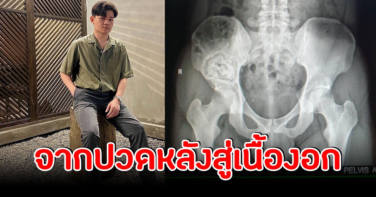 หนุ่มเล่าประสบการณ์ จากปวดหลัง สู่เนื้องอก ในวัย 26 ปี