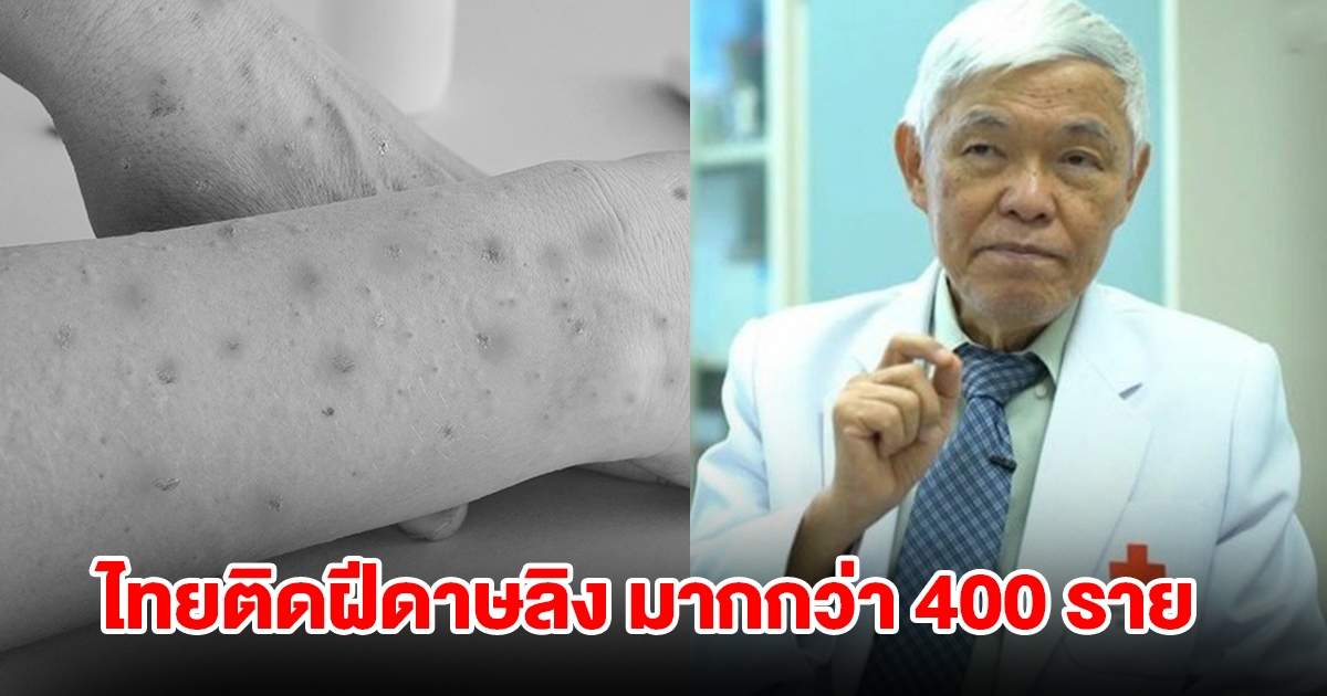 หมอยง เผย ฝีดาษลิง MPOX พบในไทยมากกว่า 400 ราย